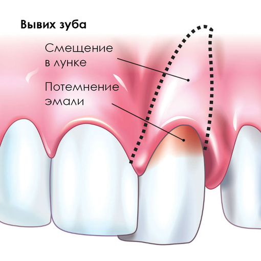 Симптомы вывиха зуба